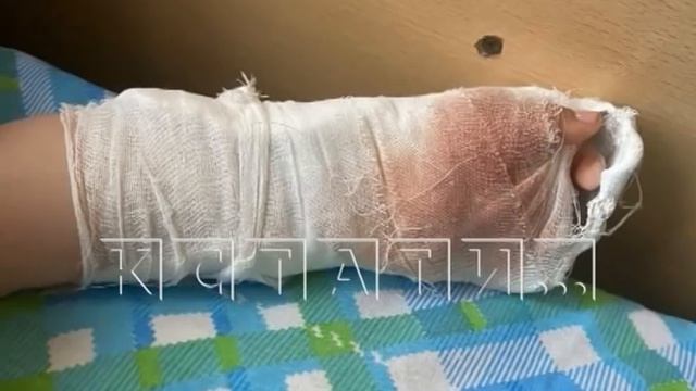 В детском саду трехлетнему ребенку оторвали часть пальца смотреть онлайн