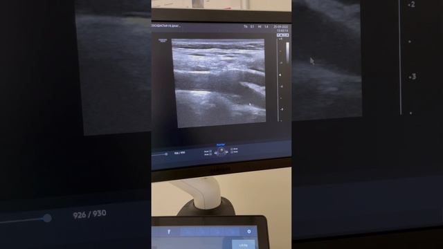 Бляшка в сонной артерии. Атеросклероз. Отложение холестерина. Узи сосудов. Сосудистый хирург Москва смотреть онлайн