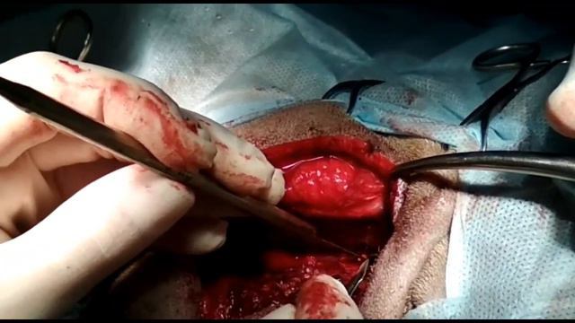 Миеломаляция смотреть онлайн