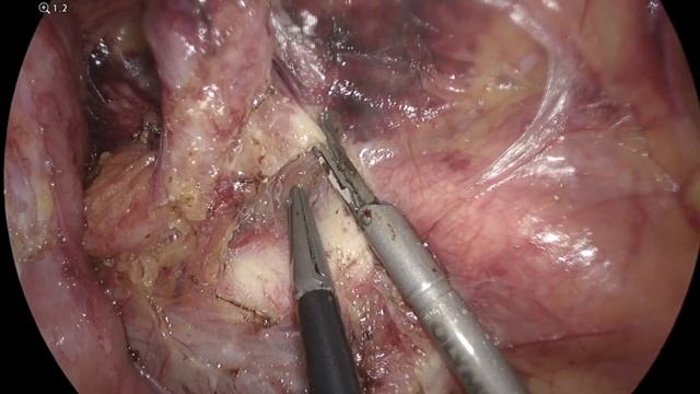 парааортальный конгломерат // парааортальная лимфодиссекция // удаление метастазов смотреть онлайн