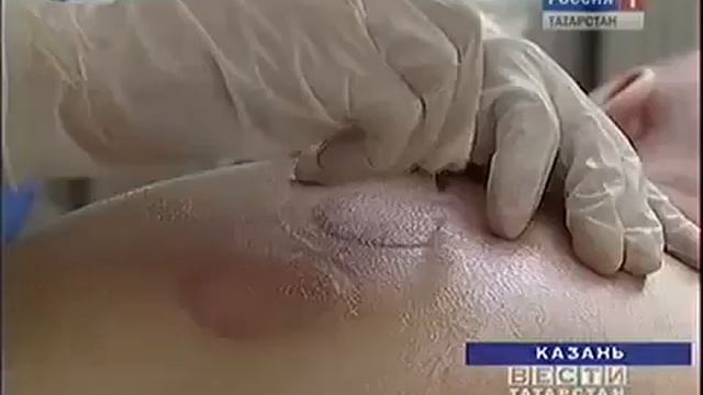 Хиджама (кровопускание) лечение по Корану! смотреть онлайн