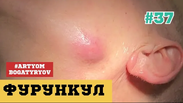 37. ФУРУНКУЛ ЧБД