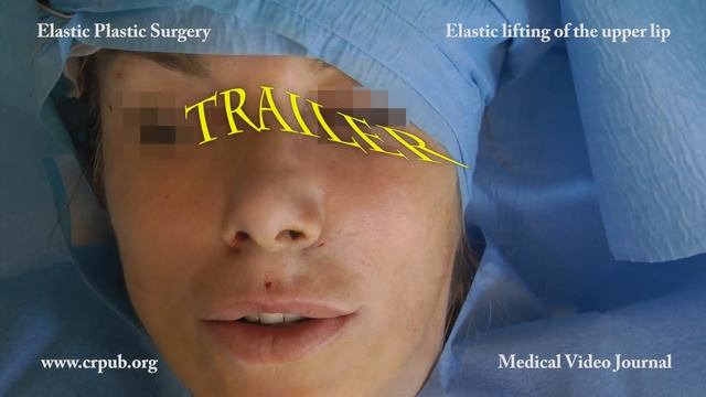 30. Lifting of the upper lip and eyebrows with the elastic thread смотреть онлайн