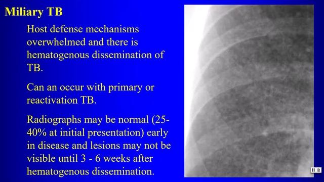 8 Pneumonia TB NTMB смотреть онлайн