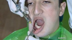 ментальная анестезия......mental anesthesia