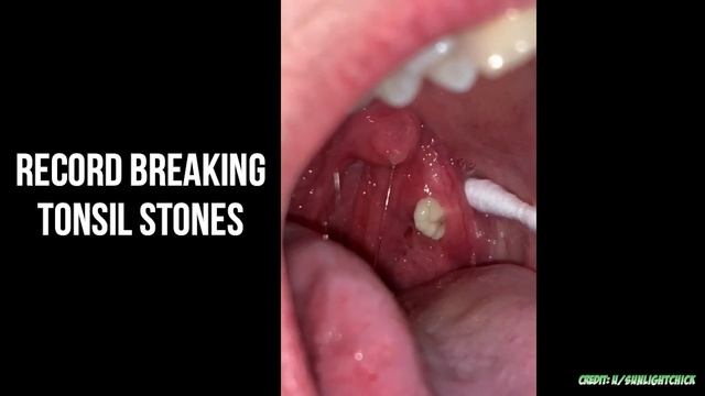 Tonsil Stones, Tonsil, Tonsil Stone Removal Tools смотреть онлайн