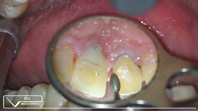 Сочетанная работа на зубе и имплантате во фронтальном отделе смотреть онлайн