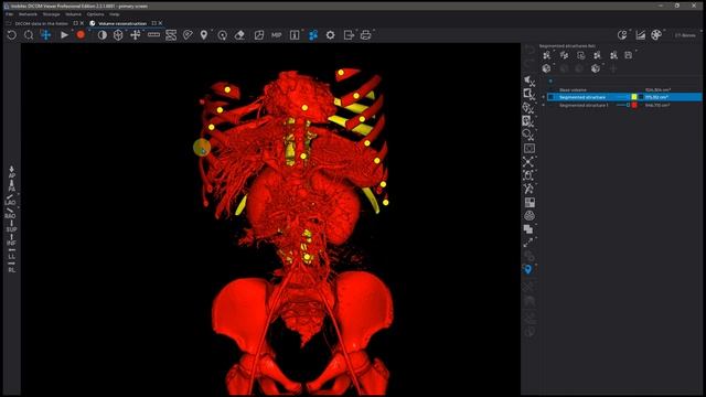 Marked watershed segmentation: bones and contrasted tissue separation смотреть онлайн