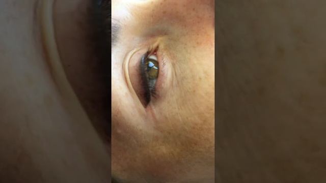 Заживший татуаж век, через месяц, 1процедура смотреть онлайн