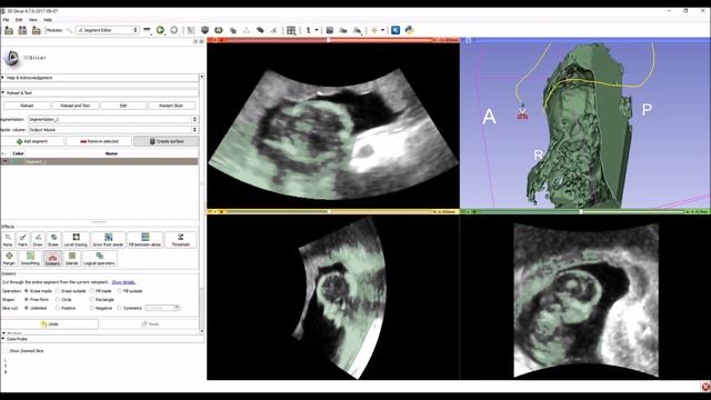 View your baby ultrasound and create 3D printable model using free software смотреть онлайн