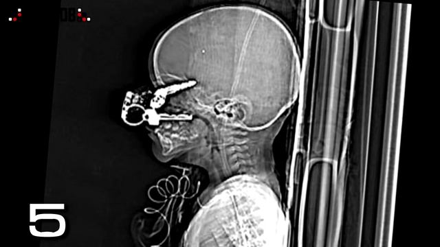 10 САМЫХ ШОКИРУЮЩИХ РЕНТГЕН СНИМКОВ. Часть 1 смотреть онлайн