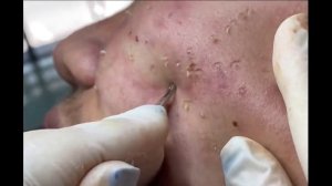 Remoção de cravo 2021 - Pimple Popping 2021- Blackhead Removal 0012