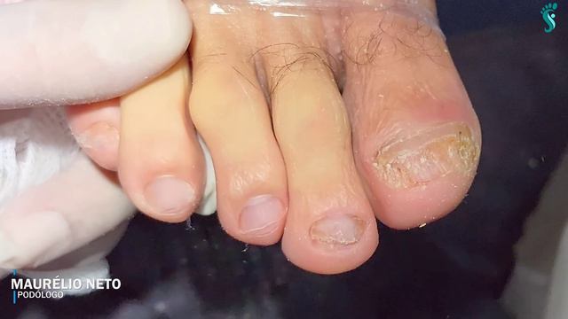 GRAU AVANÇADO DE MICOSE #podologomaurelio #nail #podologia смотреть онлайн