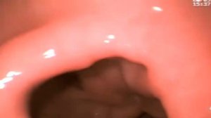 фгдс / язва луковицы 12-перстной кишки / duodenal ulcer / gastroscopy