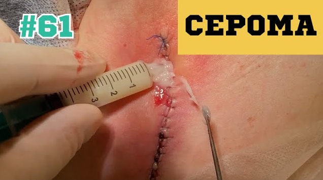61. СЕРОМА! Вот почему важно наблюдаться у врача после операции!