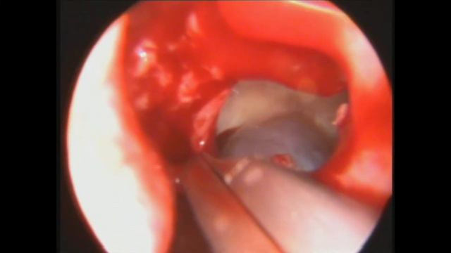 Эндоскопическое удаление кисты верхнечелюстной пазухи