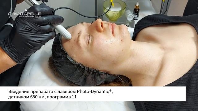 CHANTARELLE - Фотодинамическая обработка лазером PDT MASTER® и линейкой препаратов BLACK ESSENTIAL смотреть онлайн