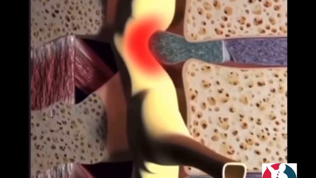 Как появляется межпозвоночная грыжа смотреть онлайн