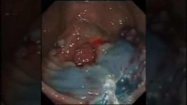 7.15-1 Эндоскопическая резекция слизистой оболочки смотреть онлайн