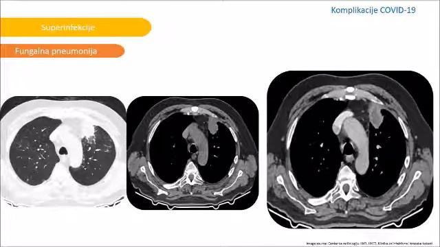 ПРЕДАВАЊЕ : РАДИОЛОШКЕ И КЛИНИЧКЕ МАНИФЕСТАЦИЈЕ COVID 19 ( Спонзорише BAYER ) смотреть онлайн