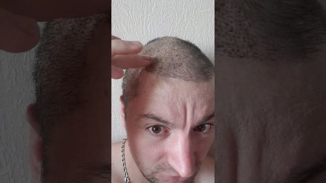 Пересадка волос 10-й день нытья смотреть онлайн