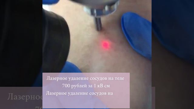 Лазерное удаление сосудов: на теле 700 рублей за 1 кв. см, на лице 900 рублей за 1 кв. см смотреть онлайн
