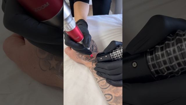 Как я удалил тату