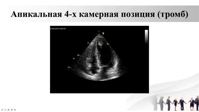 6 ЭХОКГ.mp4 смотреть онлайн