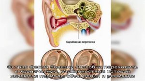 Барабанная перепонка втянута
