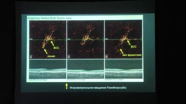 Оптимизация диагностики атипичных подтипов возрастной макулярной дегенерации Докладчик Шаимов Т.Б. смотреть онлайн