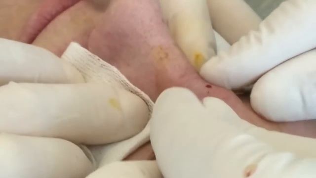 Squeezing pimple , cyst, boil!! Брызгающий Прыщ фурункул!!! смотреть онлайн
