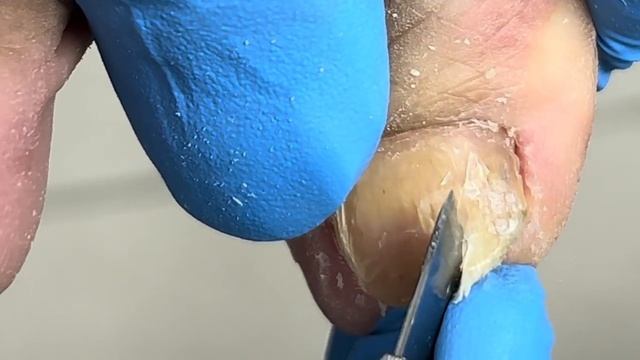 Toenails Like Jade, Onychomycosis Treatment【Xue Yidao】