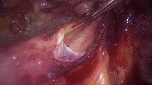 Эндовидеохирургическая пластика паховой грыжи по методике ТЕР