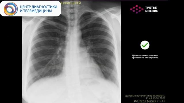 ИИ-сервис для диагностики признаков патологии ОГК при РГ ОГК и флюорографии легких ТРЕТЬЕ МНЕНИЕ