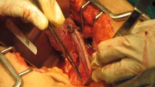 Pelvic node dissection for carcinoma endometrium смотреть онлайн