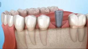 имплант,абатмент и коронка
