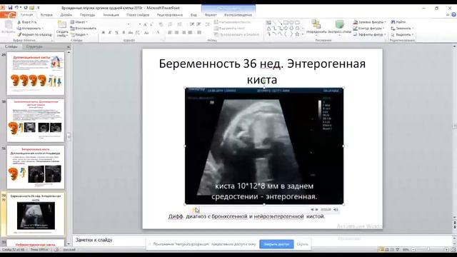 Семинар: "Пороки органов грудной клетки". смотреть онлайн