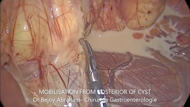 HUGE INTRAABDOMINAL CHYLOUS CYST смотреть онлайн