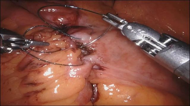 Robotic Right hemicolectomy and Retroperitonal Lymph Node Dissection смотреть онлайн