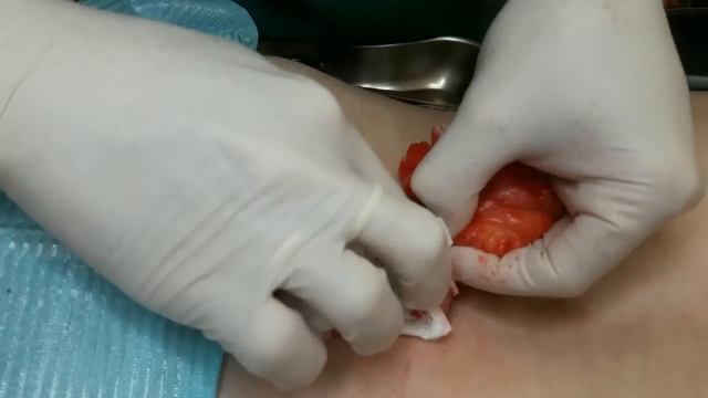 Удаление крупной липомы поясничной области при липоматозе