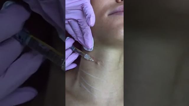 Бланширование морщин препаратом Белатеро