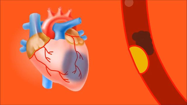 What Is A Heart Attack? Differences Between Heart Attack And Cardiac Arrest.