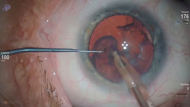 Dr.Stanimir Troshev Cataract Surgery Livestream смотреть онлайн