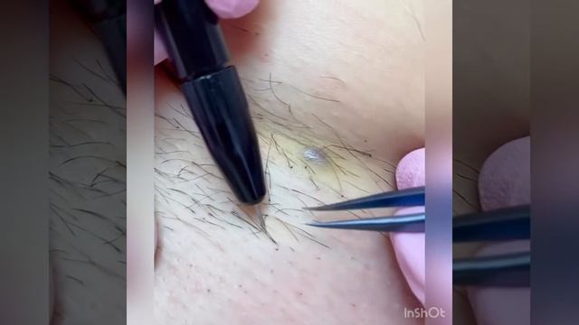 ЭлектроЭпиляция смотреть онлайн