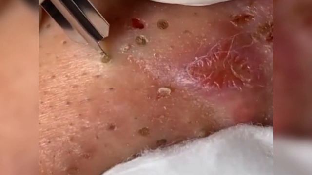 Спорим, ты любишь делать это ! Trash Compilation | Squeezing Pus |  выдавливание черных точек