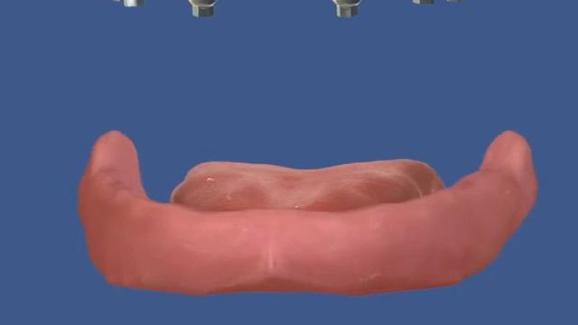 Условно съемный протез на балке - ДокторСтом Краснодар смотреть онлайн