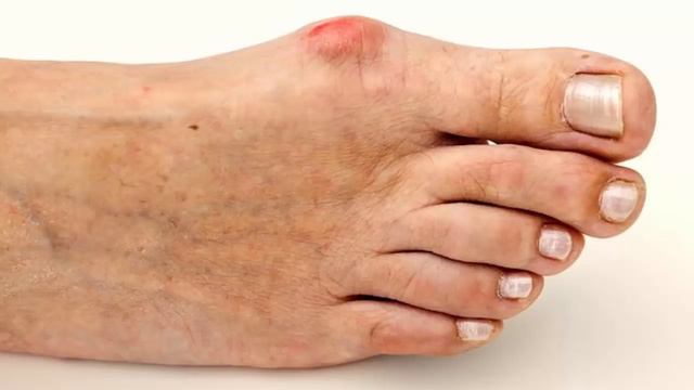 bunions how to treat bunions without surgery - get rid of bunions naturally without surgery смотреть онлайн