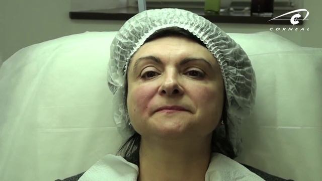 Для носогубок - контурная пластика Princess, для зоны вокруг глаз - микронидлинг! смотреть онлайн