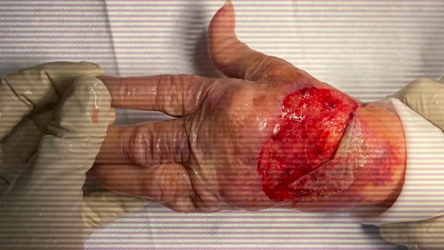 Complex Elderly "Onion" Skin Tear Repair; Wound Closure смотреть онлайн