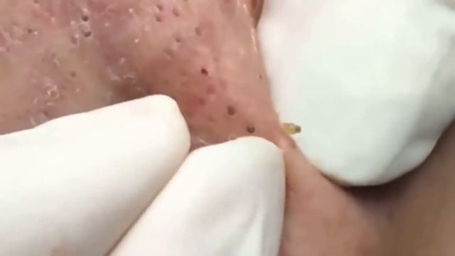 Прыщи и угри на носу. Видео подборка Relax Every Day ? август